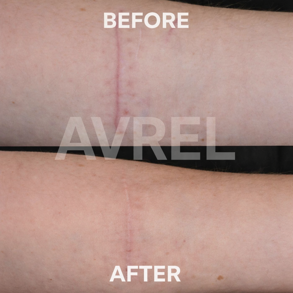 Avrel™ Scar Solutions Silicone Stick