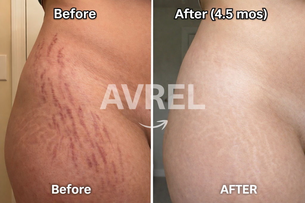 Avrel™ Scar Solutions Silicone Stick