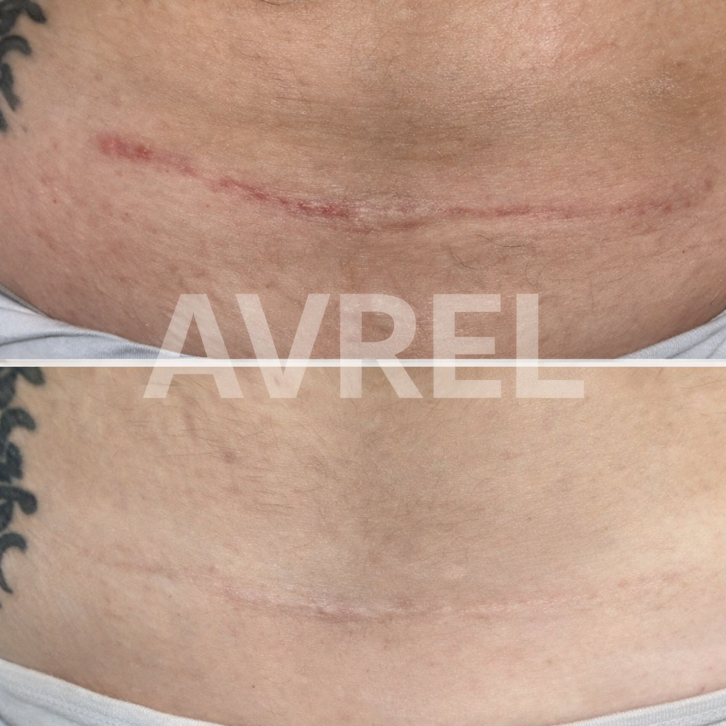 Avrel™ Scar Solutions Silicone Stick